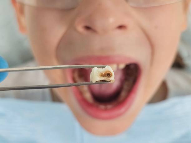 Best Emergency Wisdom Teeth Removal in Discovery Harbour, HI